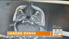 注重鼻咽健康 警惕鼻咽癌
